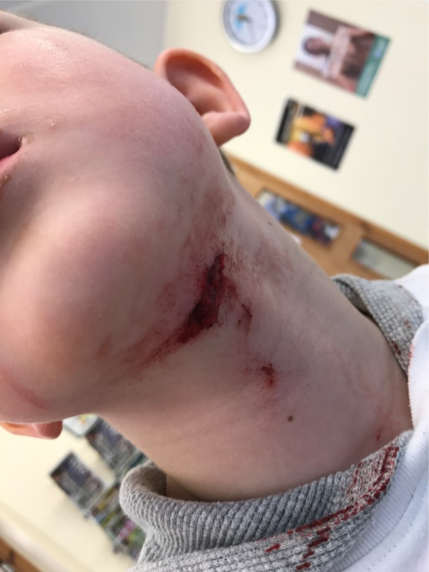 Injury to young boy