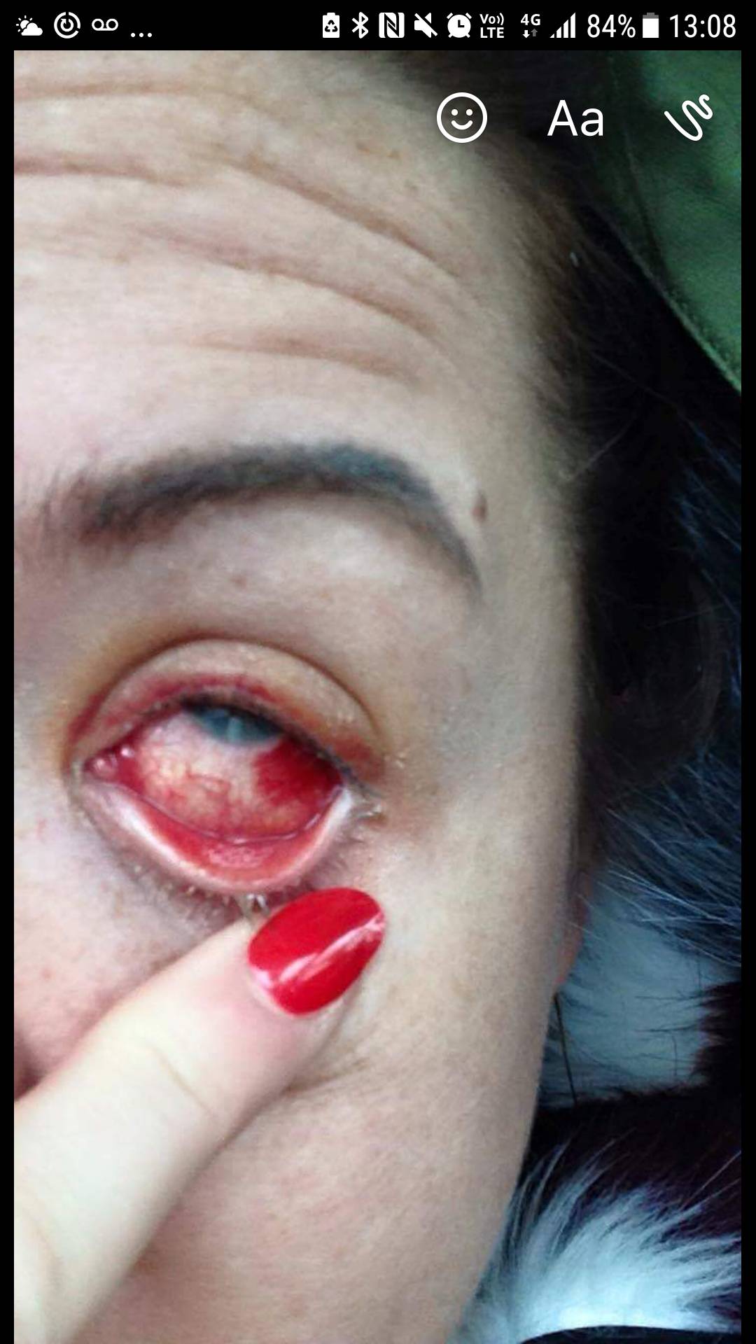 Eye damage from beauty treatment