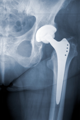 DePuy ASR implant recall