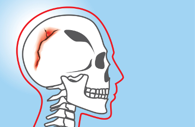 Skull fracture diagram